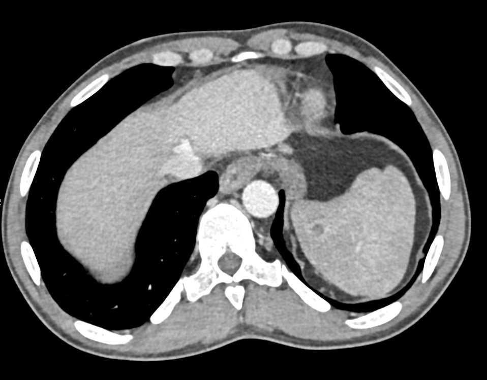 Lymphoma with Enlarged Para-Aortic Adenopathy - CTisus CT Scan