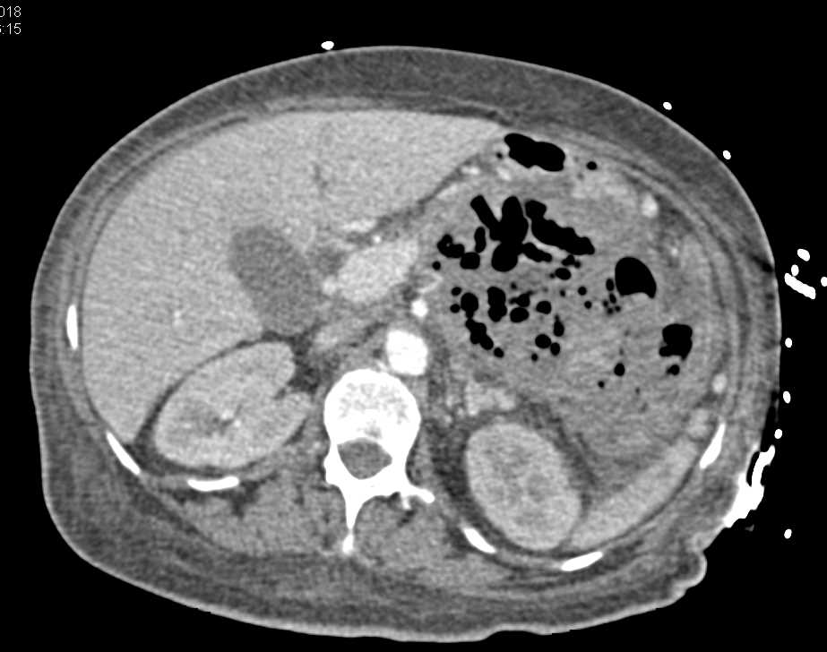 Abscess in the lesser Sac - CTisus CT Scan