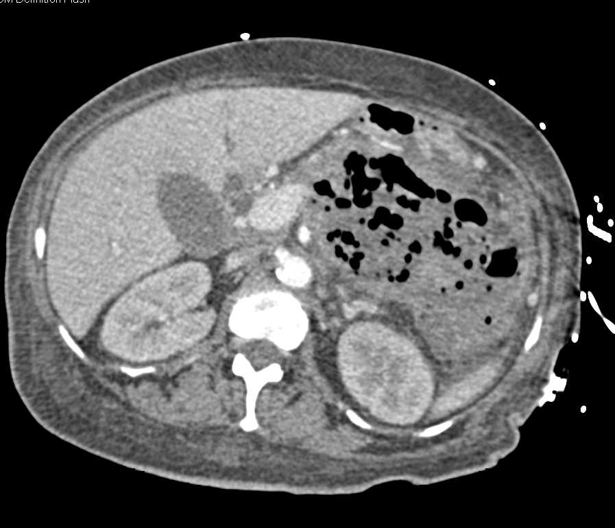 Abscess in the lesser Sac - CTisus CT Scan