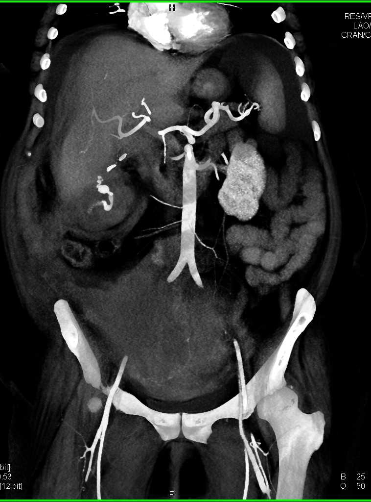 Active Bleed in the Right Lower Quadrant - CTisus CT Scan