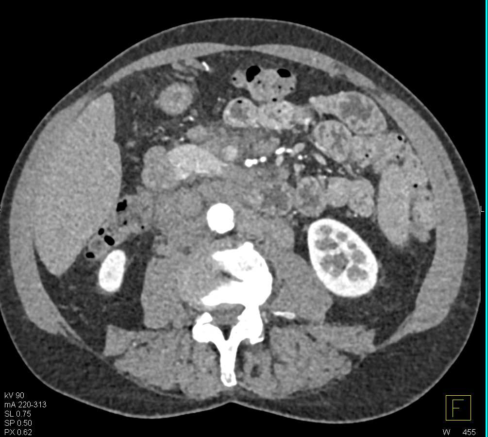 Lymphoma - CTisus CT Scan