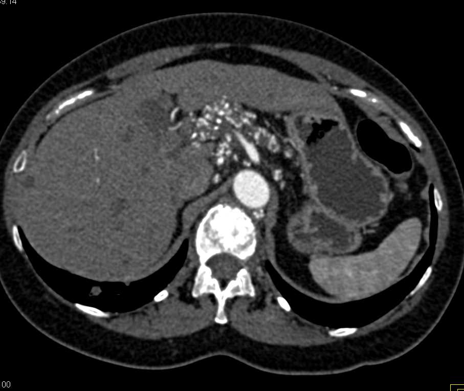High Density Nodes Due to Prior Lymphangiogram - CTisus CT Scan