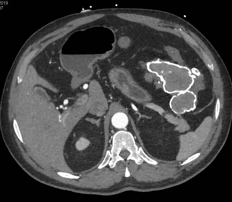 Autoinfarction Left Upper Quadrant - CTisus CT Scan