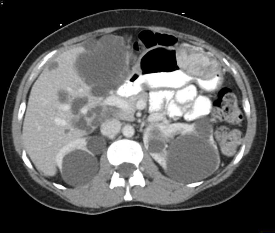 Carcinomatosis - CTisus CT Scan
