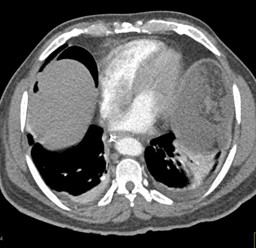 Extensive Ascites Post Op - CTisus CT Scan