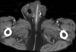 Scrotal Abscess - CTisus CT Scan