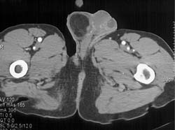 Testicular Torsion - CTisus CT Scan