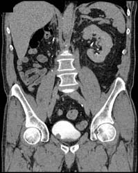 Bladder Cancer - CTisus CT Scan