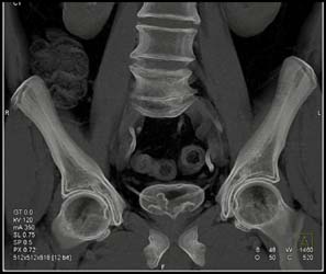 Bladder Cancer - CTisus CT Scan