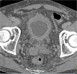 Bladder Cancer With Thickened Left Ureter - CTisus CT Scan