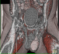Testicular Abscess and Scrotal Abscess - CTisus CT Scan