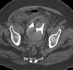 Bladder Cancer - CTisus CT Scan
