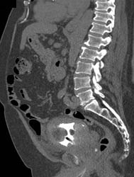 Bladder Cancer - CTisus CT Scan
