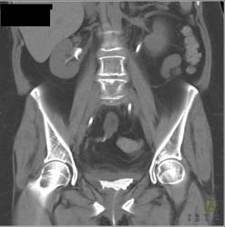 Normal CT Urogram and Cystogram - CTisus CT Scan