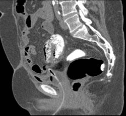 CT Cystogram With Fistulae to Colon - CTisus CT Scan