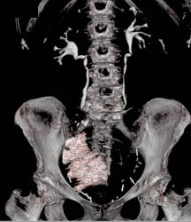 Neobladder - CTisus CT Scan