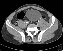 Infection in Urachal Remnant - CTisus CT Scan