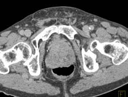 Enlarged Prostate - CTisus CT Scan
