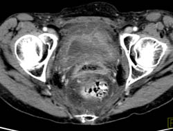 Radiation Cystitis and Proctitis - CTisus CT Scan