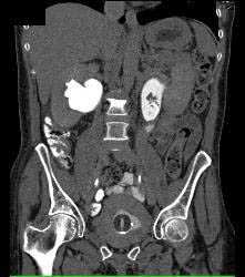 Bladder Cancer With Obstruction - CTisus CT Scan