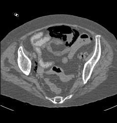 Emphysematous Cystitis - CTisus CT Scan
