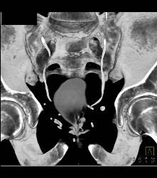 Pelvic Hematoma S/p Prostatectomy - CTisus CT Scan