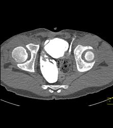 Neobladder With Leak - CTisus CT Scan