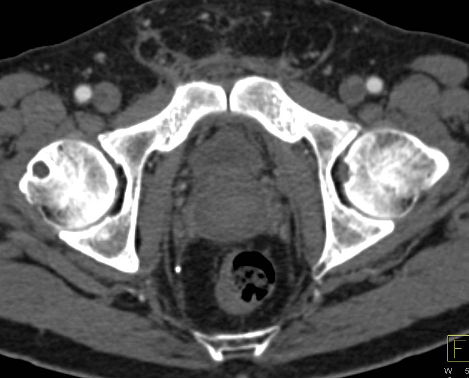 Hematoma in Prostate Bed Following Resection with Bladder Deformity - CTisus CT Scan