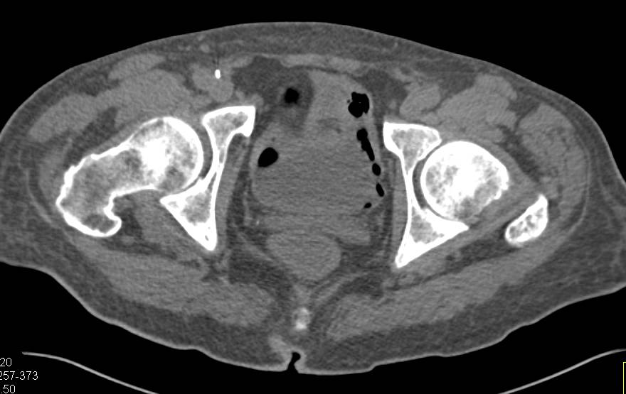 Emphysematous Cystitis - CTisus CT Scan