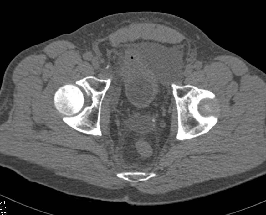 CT Cystogram shows Bladder Contrast Extravasation Extraperitoneal Type s/p Prostatectomy with Da Vinci System - CTisus CT Scan
