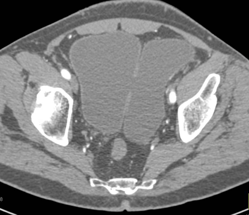 Large Left Sided Bladder Diverticulum - CTisus CT Scan