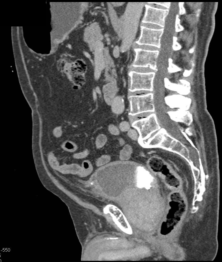 Prostate Cancer Involves the Base of the Bladder - CTisus CT Scan