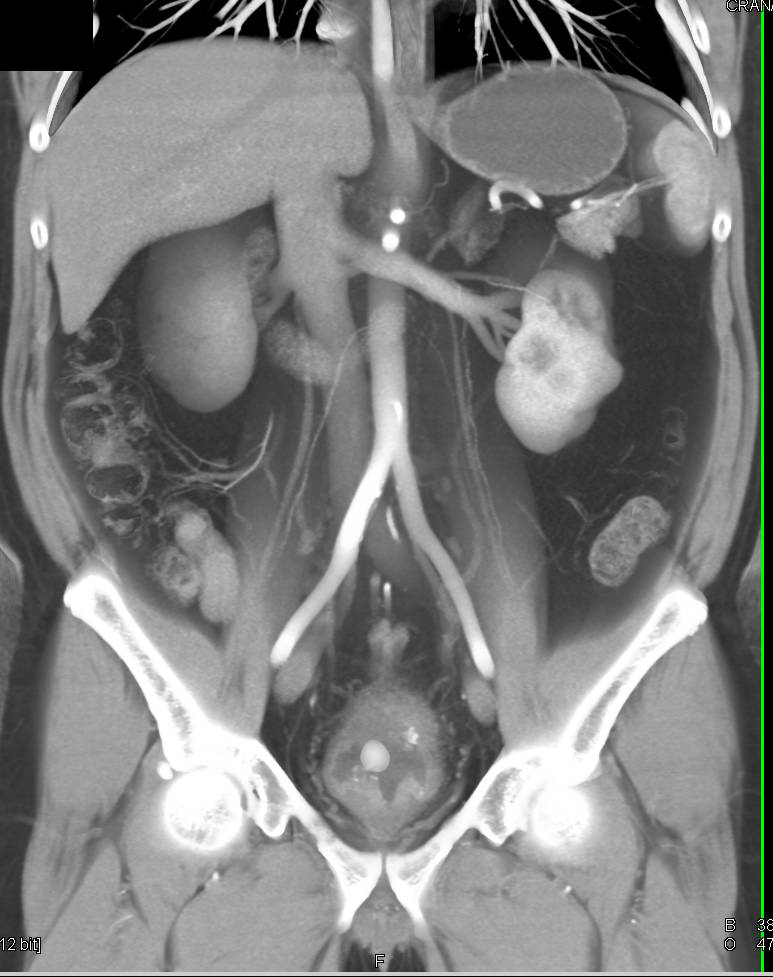 Bladder Cancer Seen Nicely on Arterial Phase Imaging but also on CT Urography - CTisus CT Scan