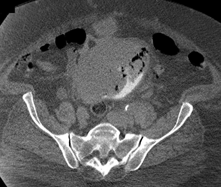 Bladder Adenocarcinoma - CTisus CT Scan