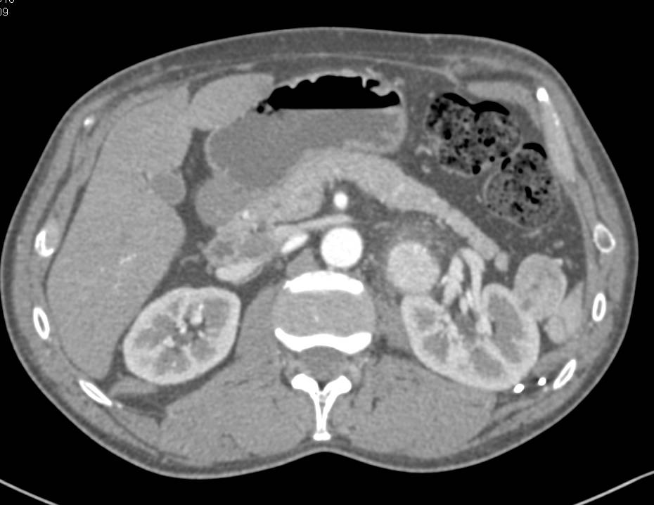 Paraganglioma Near the Left Kidney. Note the Mass is Very Vascular - CTisus CT Scan