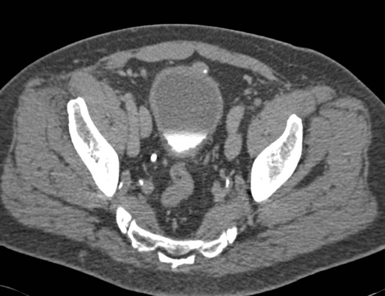 Carcinoma in Urachal Remnant - CTisus CT Scan