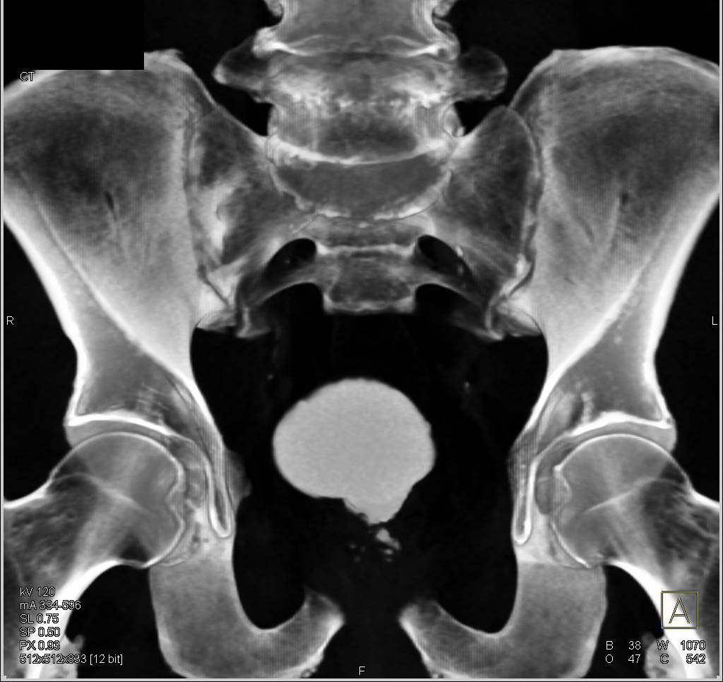 Prostate Cancer Involves the Base of the Bladder - CTisus CT Scan