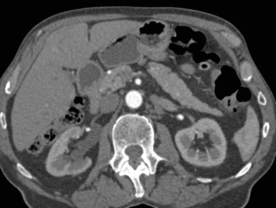 Right Hydronephrosis with a Stricture in the Distal Right Ureter - CTisus CT Scan