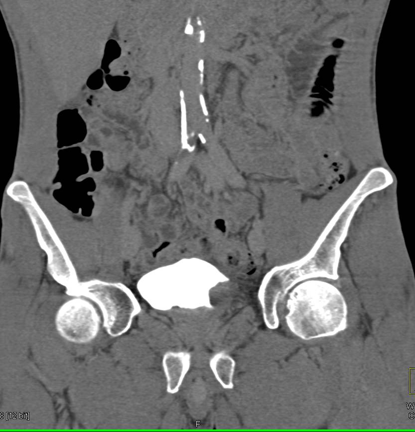 Bladder Cancer - CTisus CT Scan