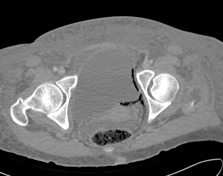 Emphysematous Cystitis - CTisus CT Scan