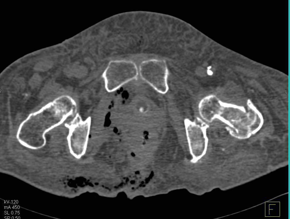 Necrotizing Fasciitis without Bladder Involvement on CT Cystogram - CTisus CT Scan