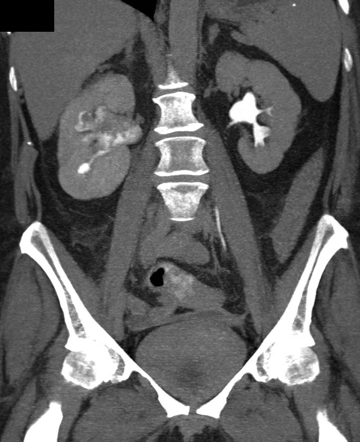 Transitional Cell Carcinoma of the Right Renal Pelvis - CTisus CT Scan