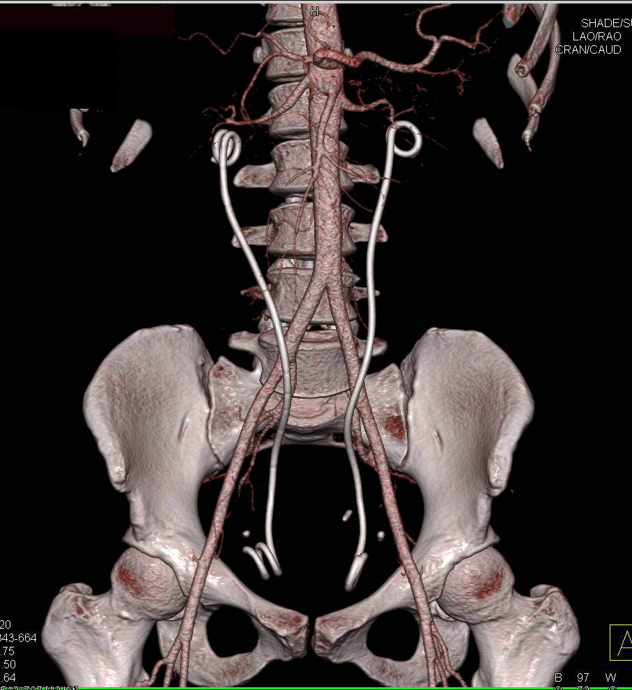 Retroperitoneal Fibrosis (RPF) with Medially Deviated Ureters (with stents) - CTisus CT Scan