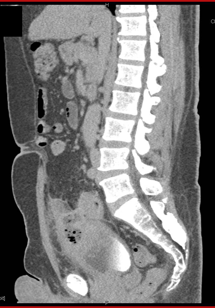 Urachal Carcinoma with Central Necrosis - CTisus CT Scan