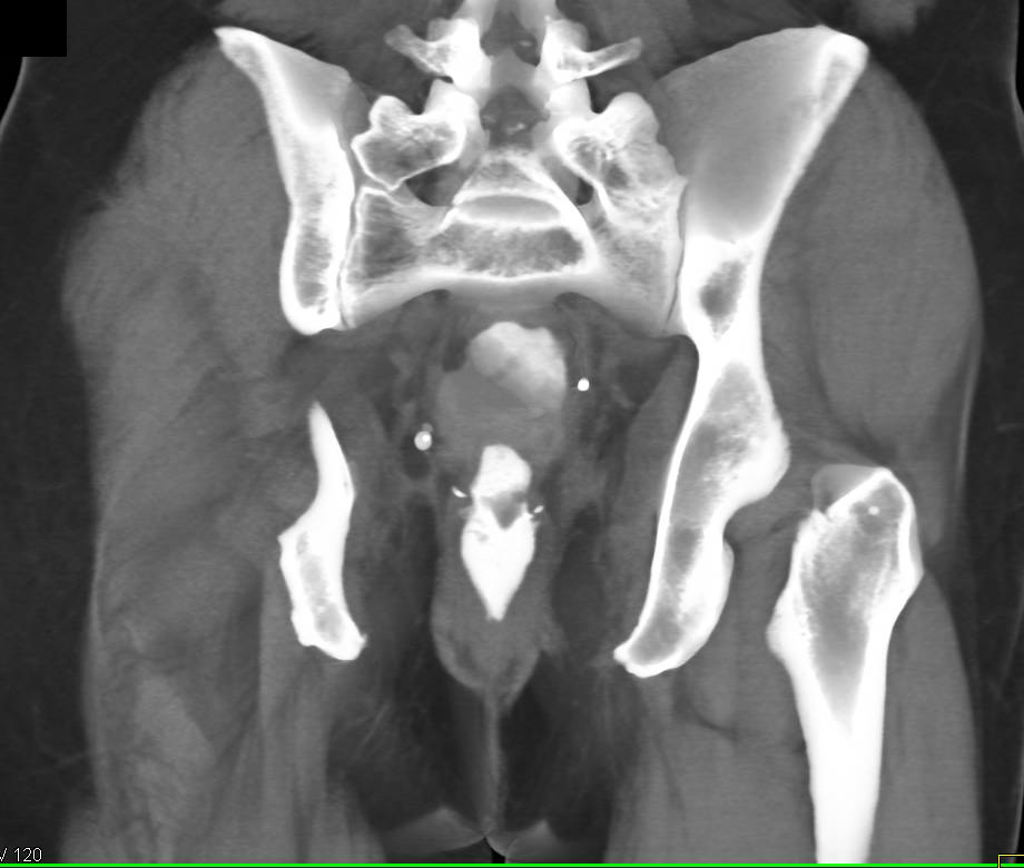 CT Cystogram with Fistulae Between Bladder and Rectum - CTisus CT Scan