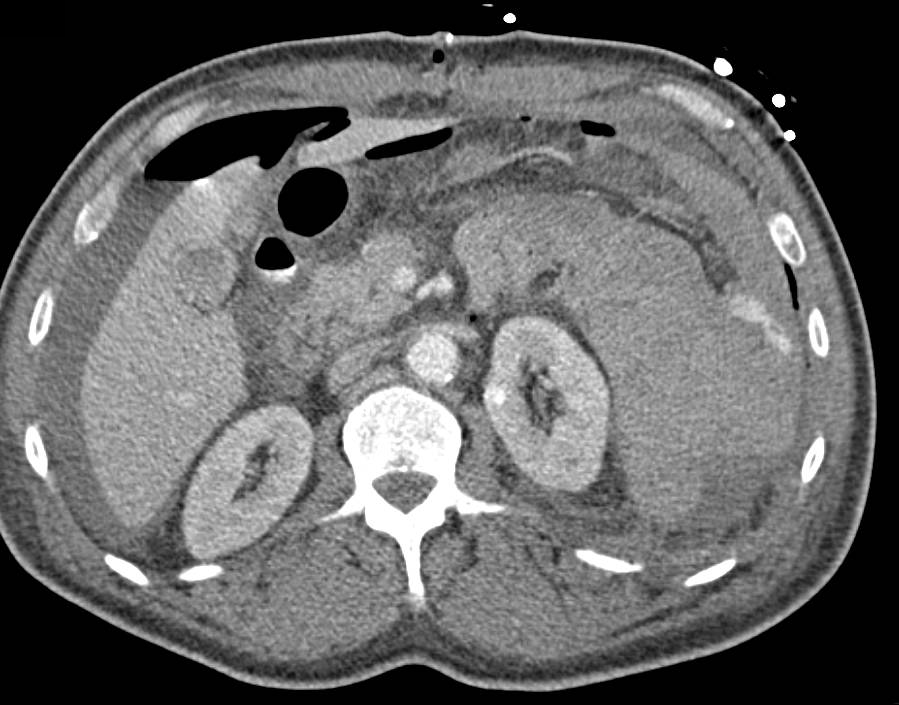 Active Bleed Left Upper Quadrant Nicely Seen on 3D Imaging - CTisus CT Scan