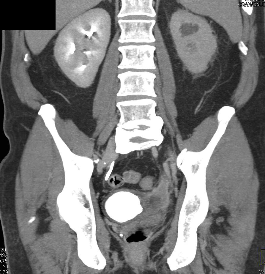 Bladder Cancer Obstructs the Left Ureter - CTisus CT Scan