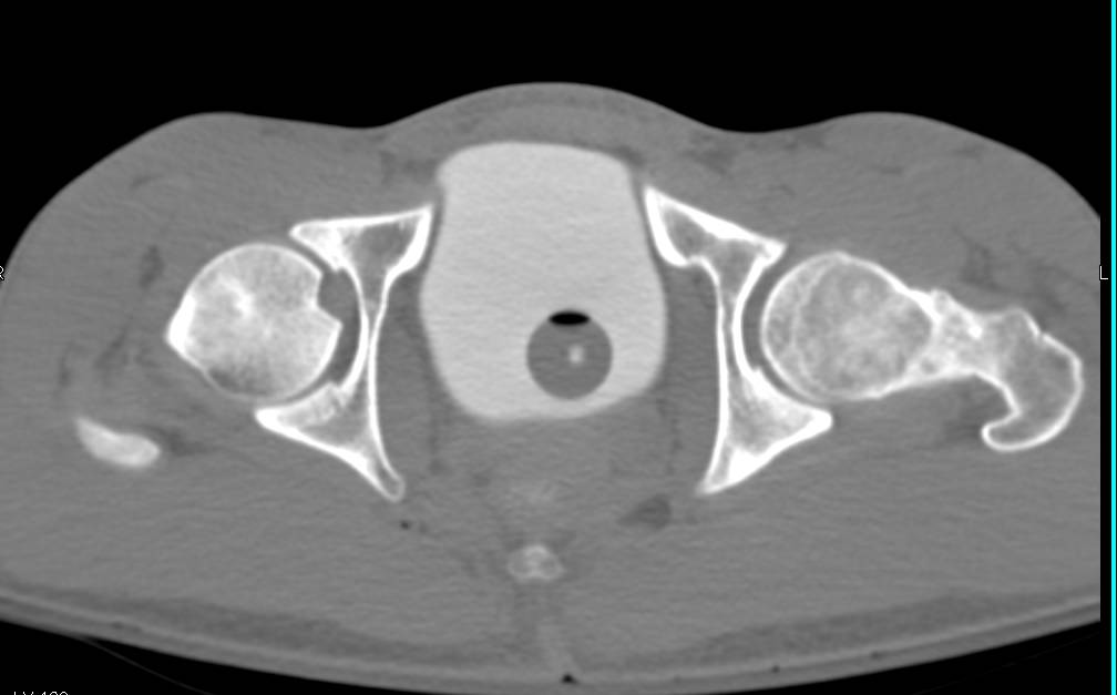 CT Cystogram Without Contrast Extravasation S/P GSW - CTisus CT Scan