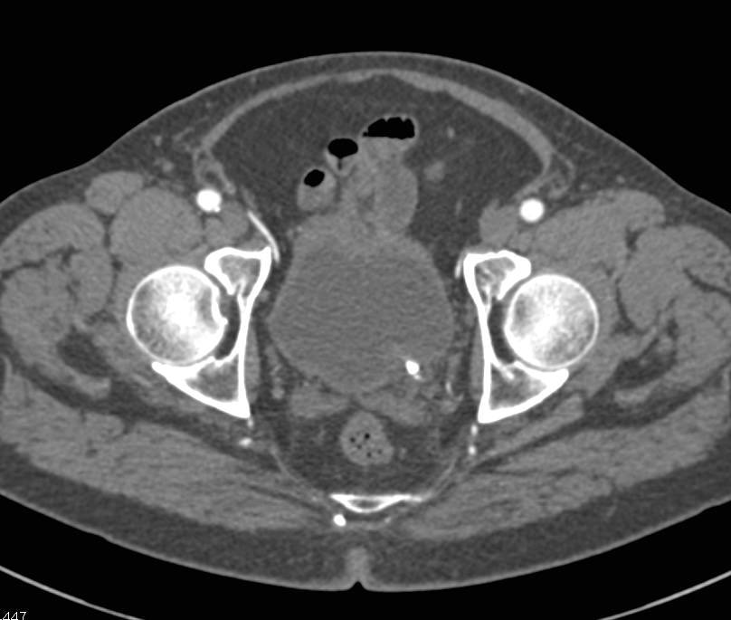 Enlarged Prostate due to Prostate Cancer - CTisus CT Scan