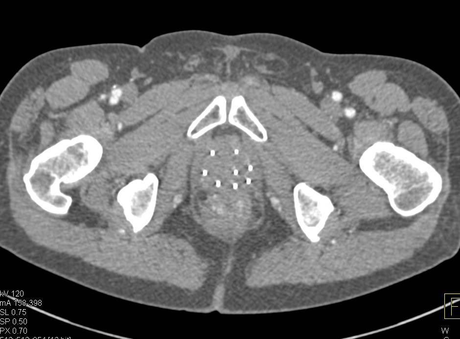 Radioactive Seeds in a Patient with Prostate Cancer - CTisus CT Scan
